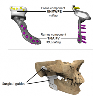 Custom TMJ 1 e1484225918591