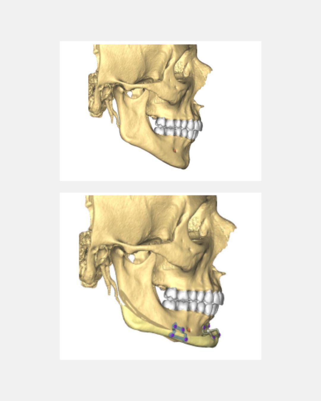 CHIN WING OSTEOTOMY   CHIN WING GENIOPLASTIE avec guidage chirurgical MATERIALISE  6 mois pe