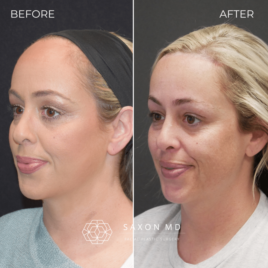 5809804 Copy of Before 1 1024x1024