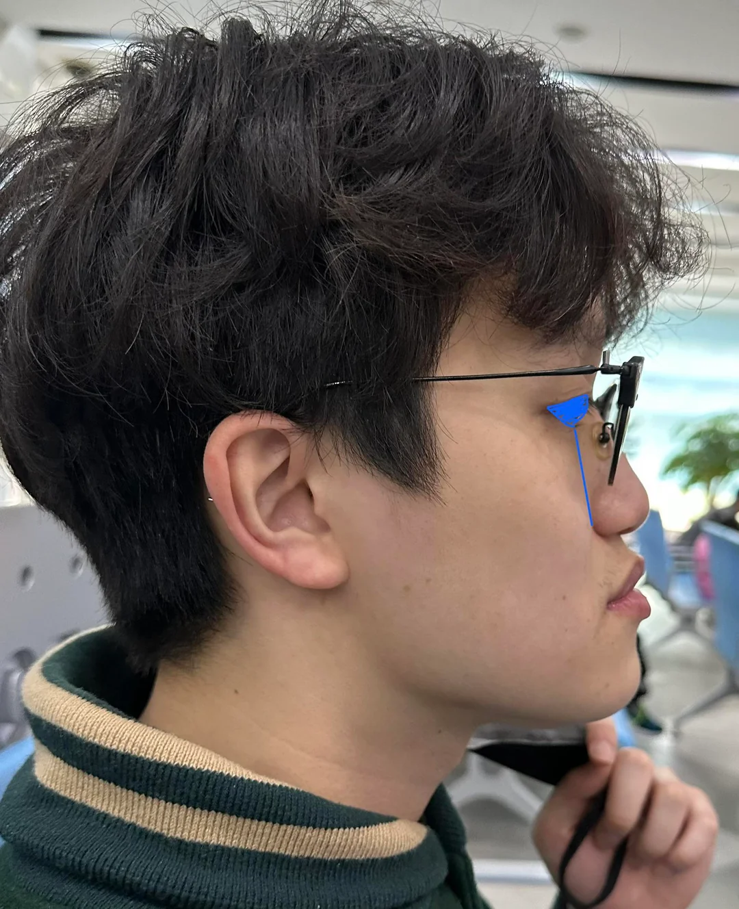 Do i have a recessed maxilla im not sure what other v0 bkkd4v99deca1