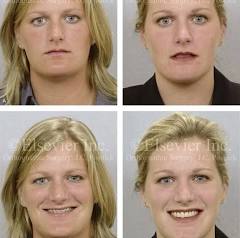 Short Face Growth Patterns: Maxillomandibular Deficiency ...