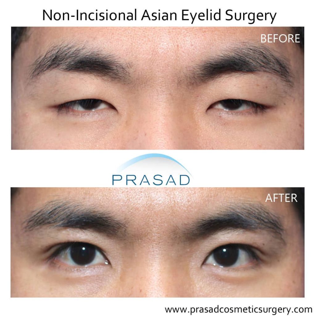 Nonincisional Asian eyelid surgery before and after 1 1024x1024