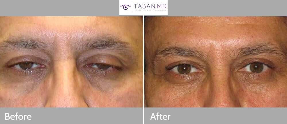 Droopy eyelid ptosis 1