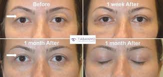 Upper Blepharoplasty Before and After ...