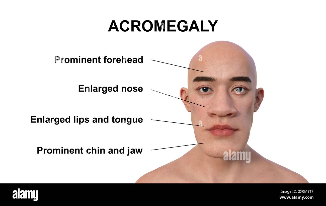 3d illustration of a man with acromegaly this is a condition causing an increase in the size o