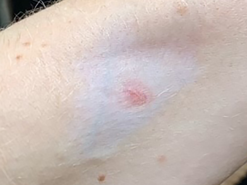 RoKi atrophy hypopigmentation steroid injection 800x600 1