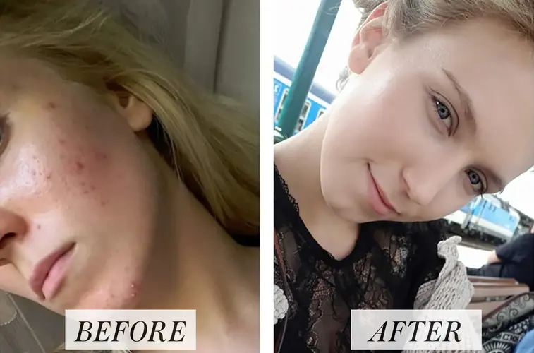 accutane-before-after-acne.webp