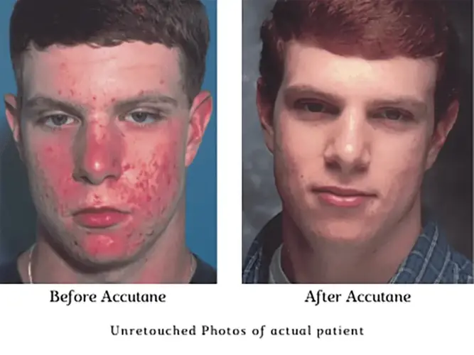 accutane before and after.webp