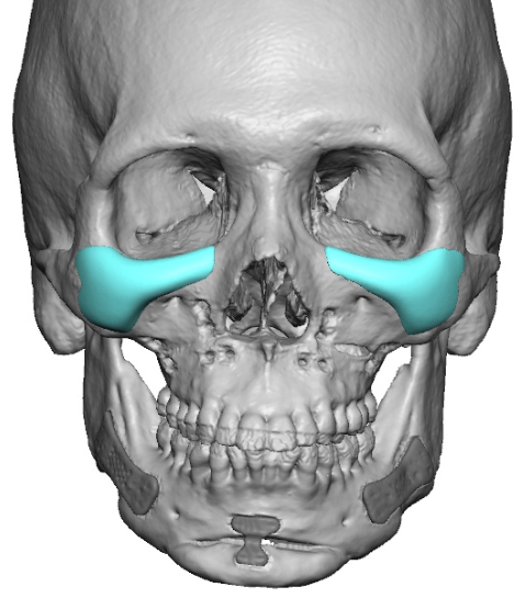 custom-silicone-IOM-implant-replacements-design-front-view-Dr-Barry-Eppley.png