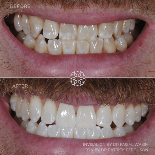 Invis Icon before after 1024x1024