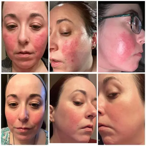 tret-025-as-part-of-my-rosacea-type-2-routine-almost-4-v0-wz3677v64ri81.webp