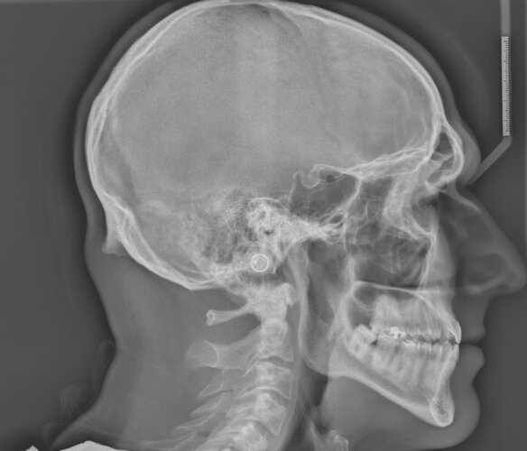 Cephalometric xray.JPG