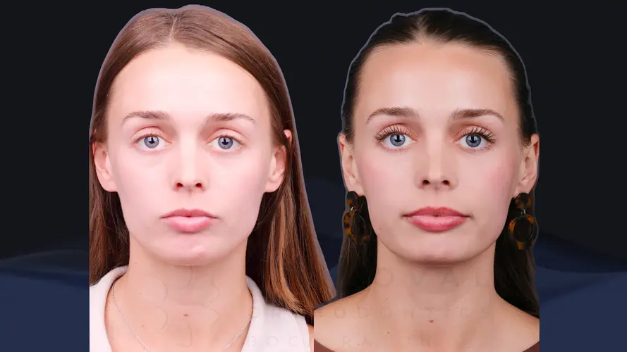 6877ee8ea5e99fb969bcb2ec_Aesthetic MARPE treatment with no diastema before.webp