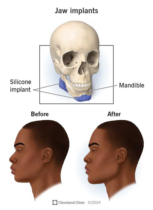 jaw-implants-illustration.jpg