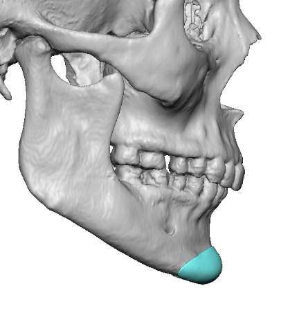 female-custom-chin-implant-side-view-DR-Barry-Eppley.png