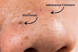 What are blackheads? Facts and The Best ...