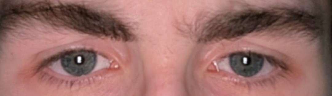 Cooked eye