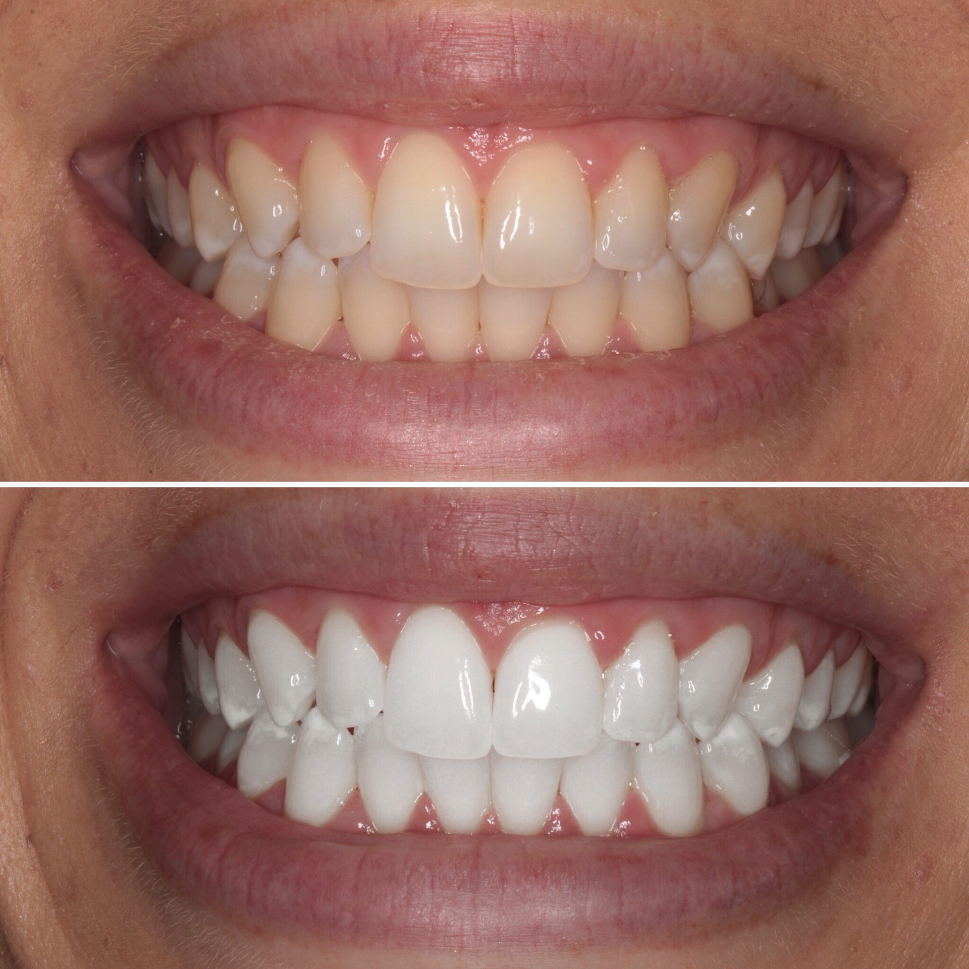Professional dental bleaching