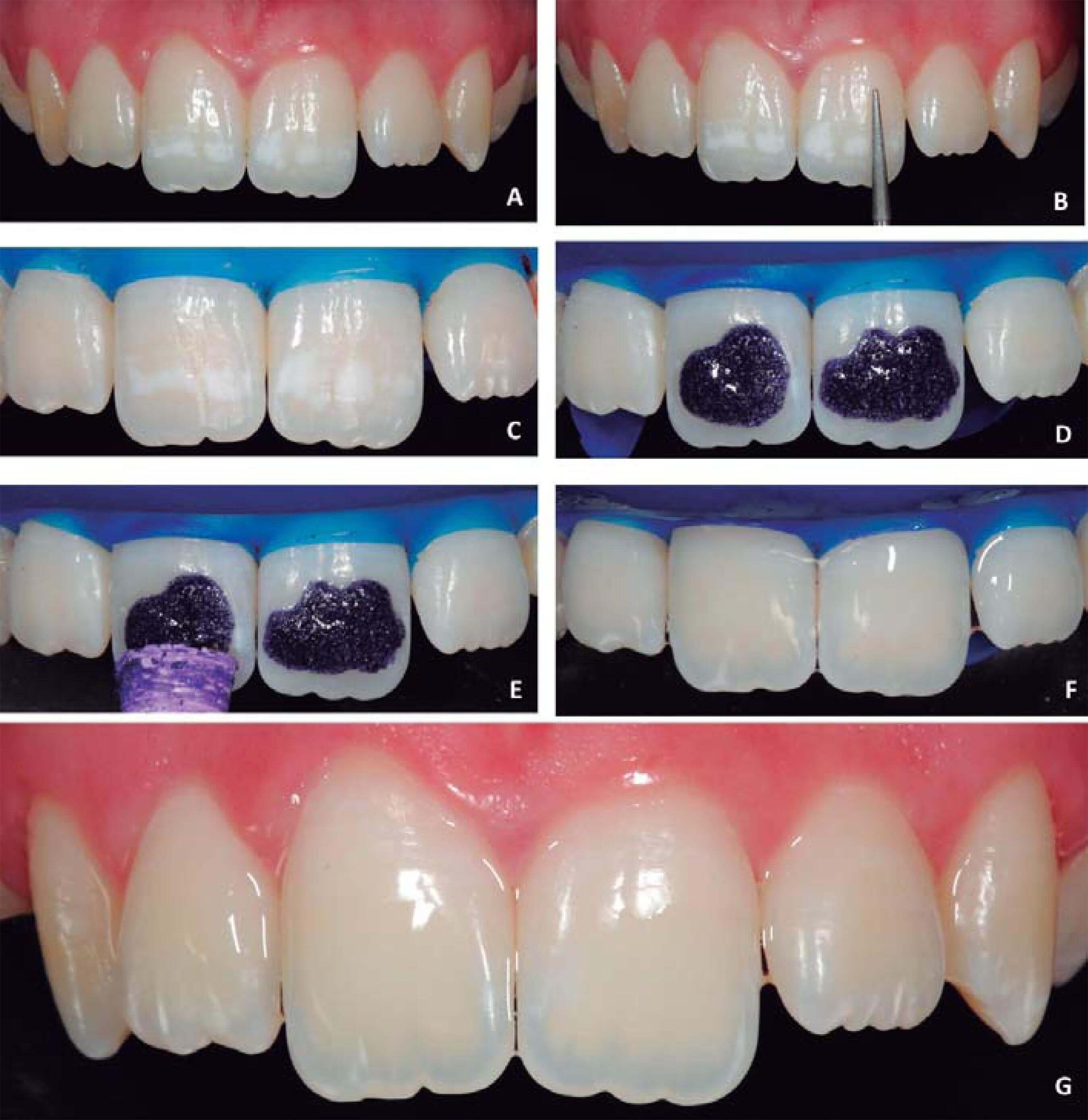 Microabrasian and enamel abrasian