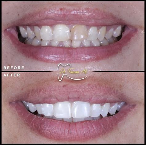 Internal tooth bleaching