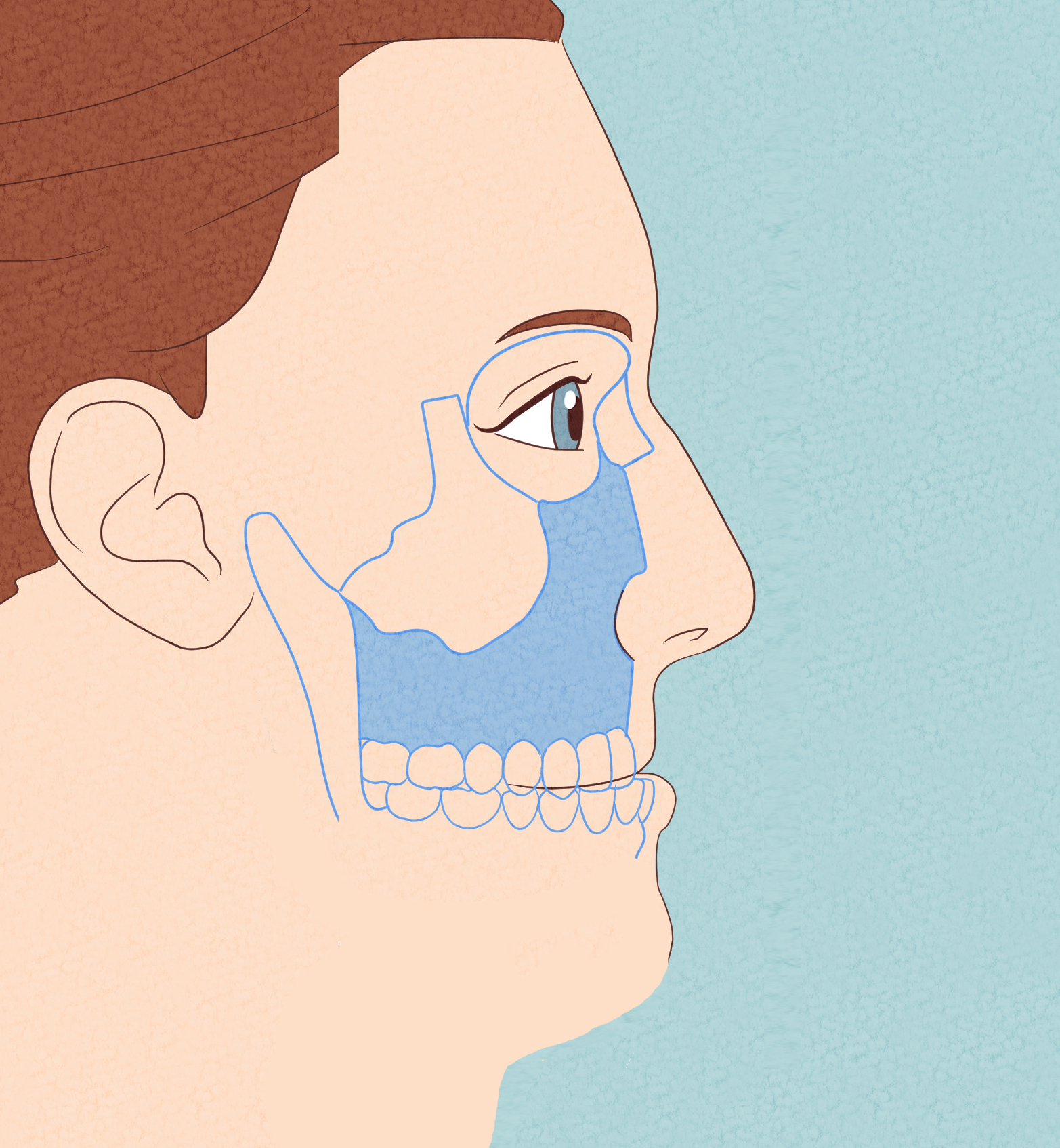 Recessed Maxilla Summary