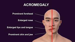 Acromegaly/ Excess Growth Hormone - The ...