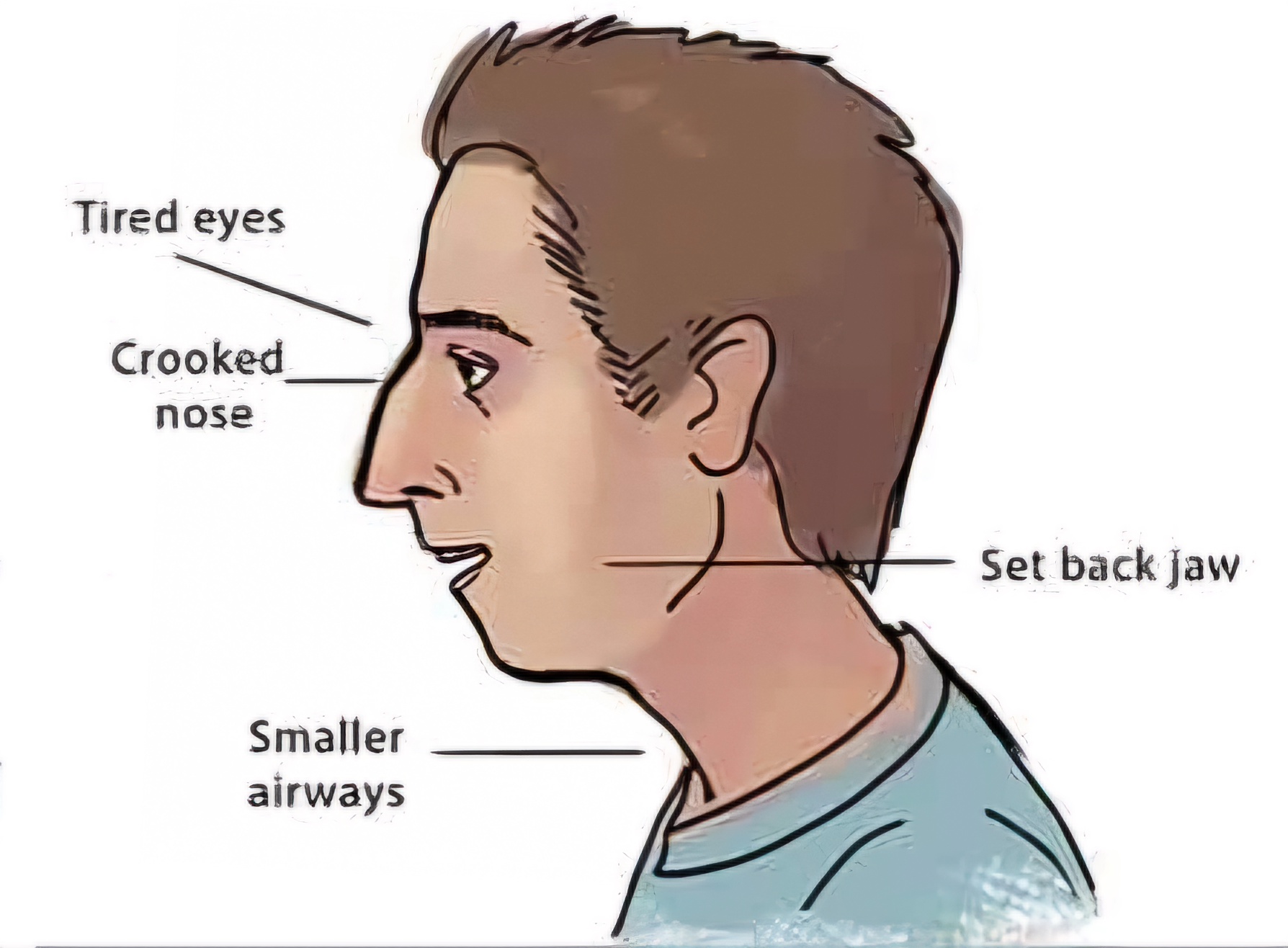 Mouth breathing face vs nose breather