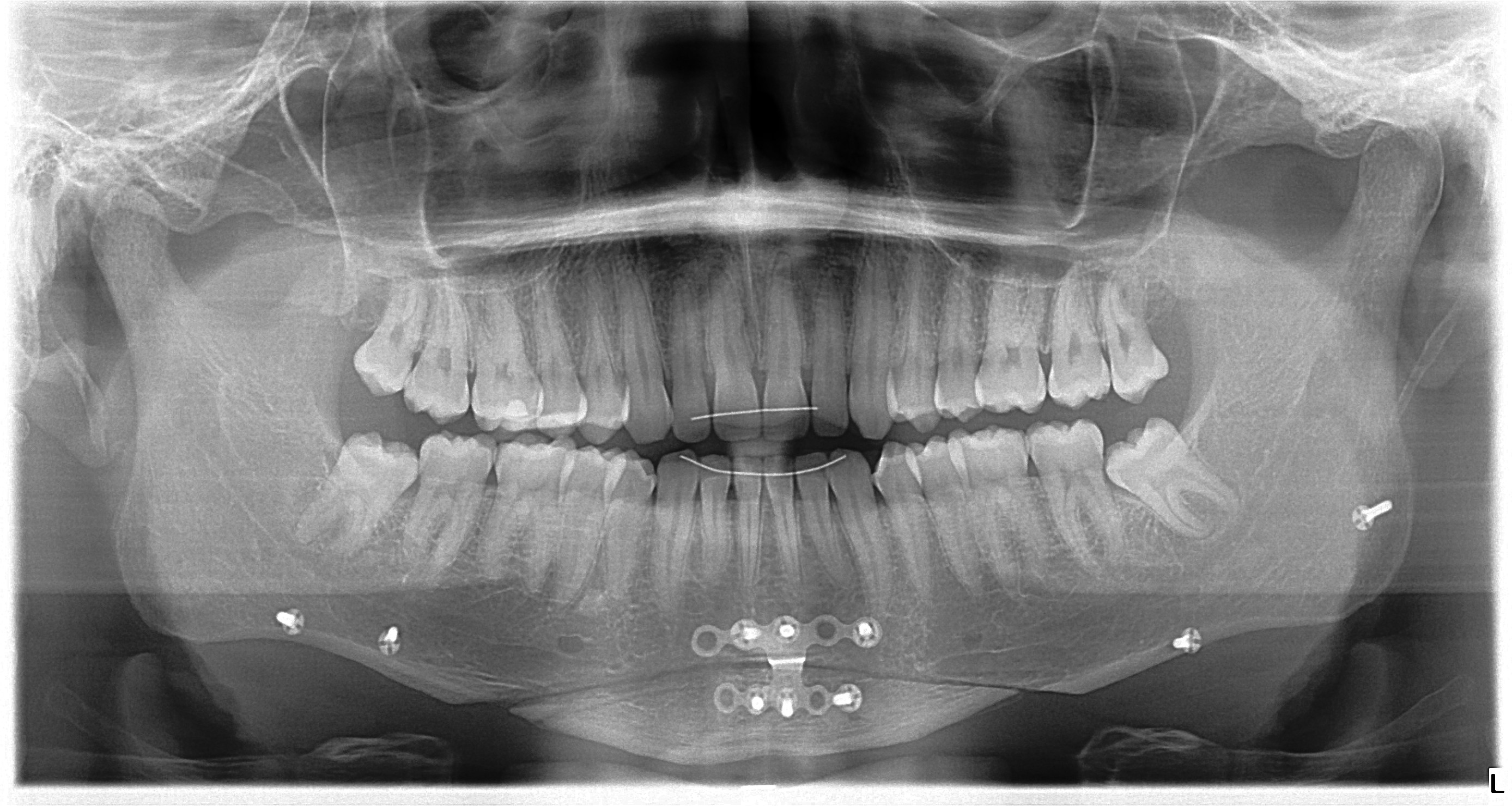Xray