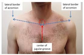 Impact of Clavicular Shortening after ...