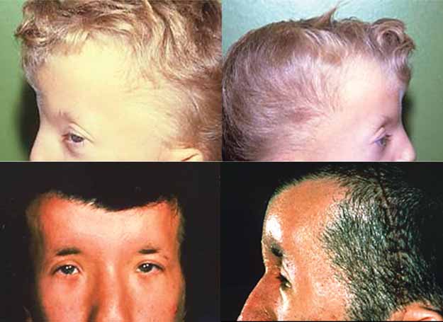 Supraorbital RidgesUnderdeveloped large