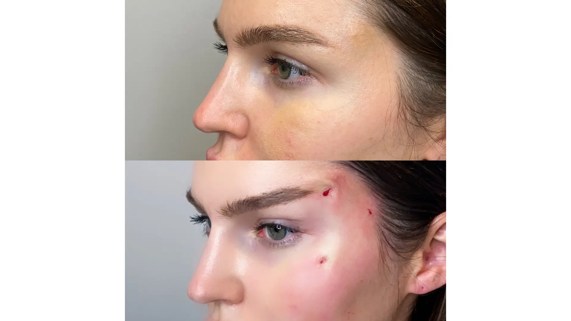 1 Benefits of PDO Thread Lift for Brow Rejuvenation