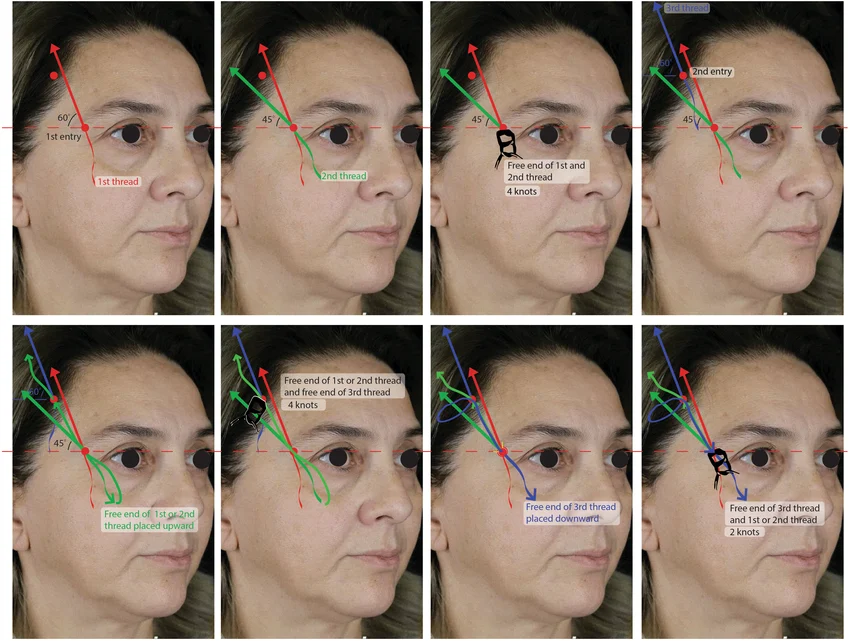 Eyebrow thread lifting technique step by step schematic description