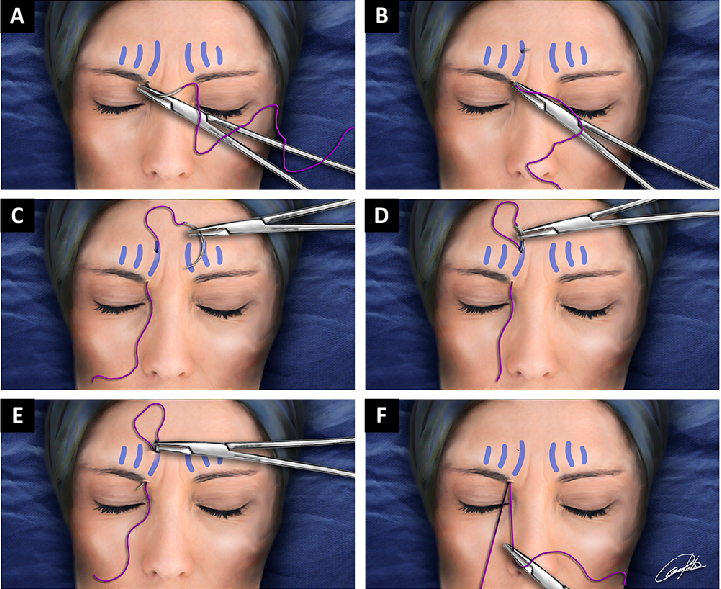 A Begin with the needle on the bottom edge of the superciliary follicles B The passage