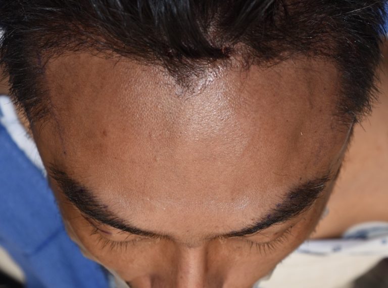 Ciustom brow bone implant and teporal implants intraop top view 1 Dr Barry bEppley 768x569