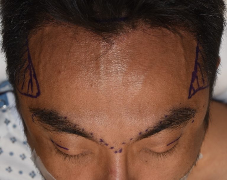 Ciustom brow bone implant and teporal implants intraop top view 2 Dr Barry bEppley 768x607