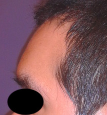 Forehead 2b male forehead augmentation before Dr Barry Eppley Indianapolis