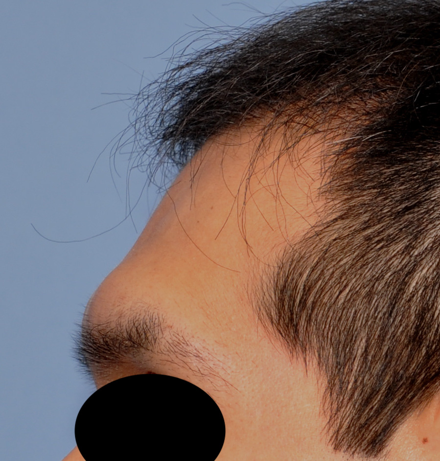 Forehead 2a male forehead augmentation side before dr barry eppley indianapolis