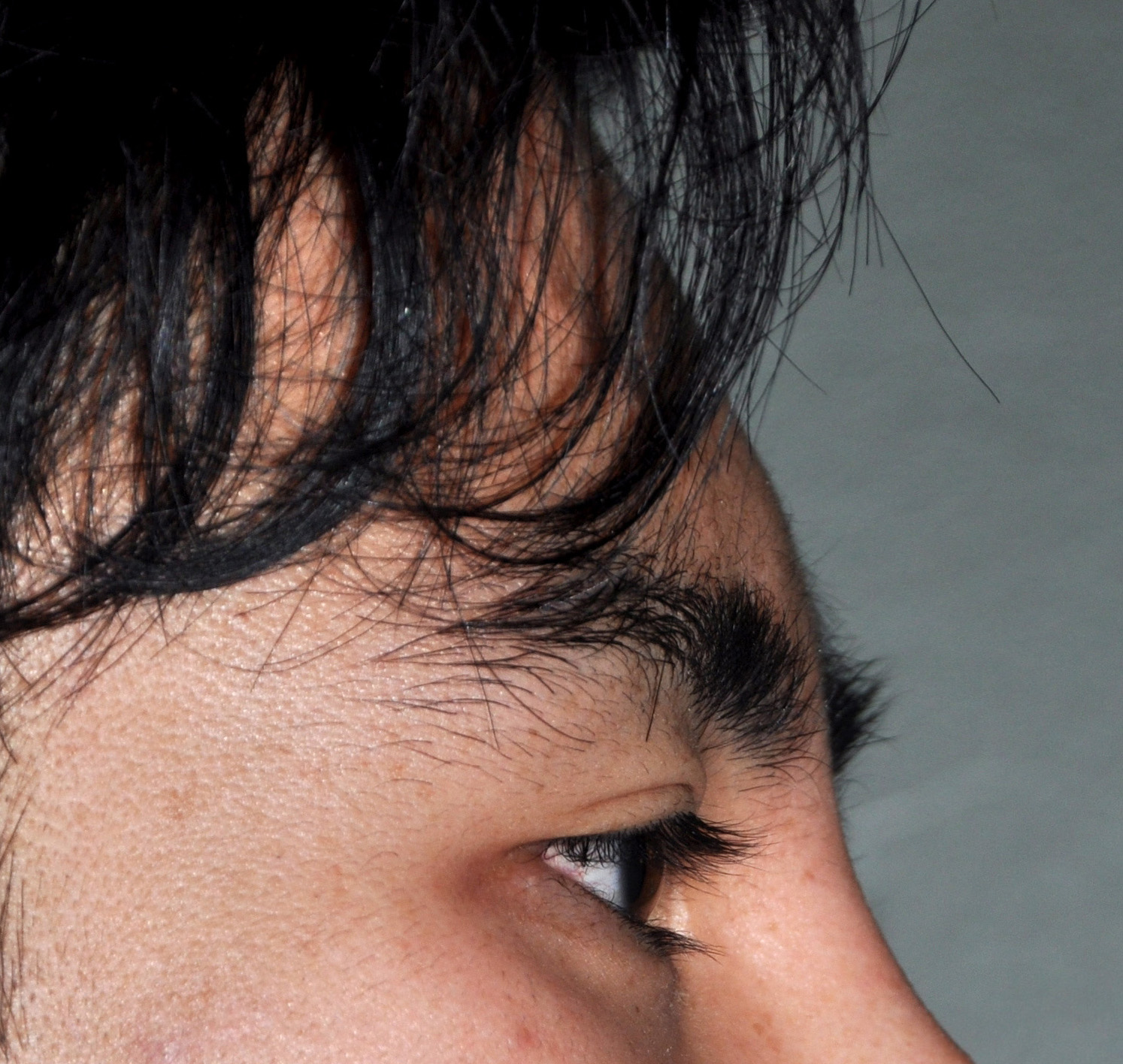 Forehead 8a custom forehead implant side before Dr Barry Eppley Indianapolis