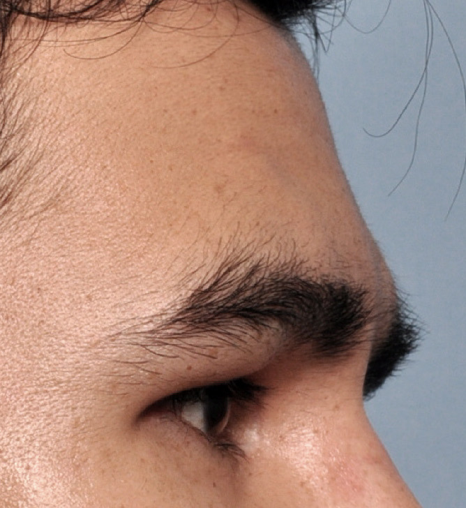 Forehead 8b custom forehead implant side after
