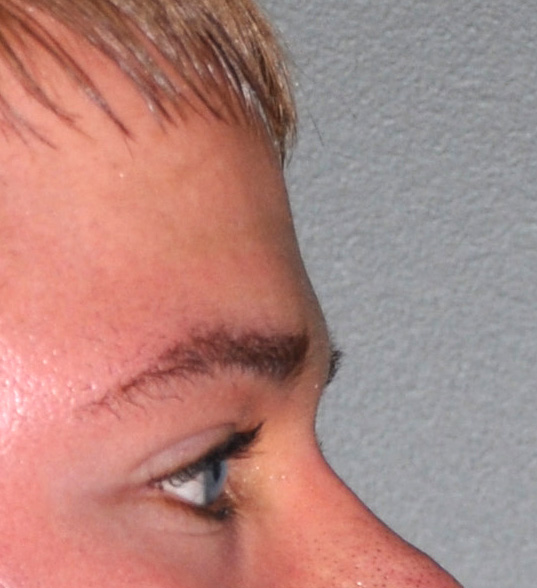 Forehead 9a brow bone implant side before Dr Barry Eppley Indianapolis