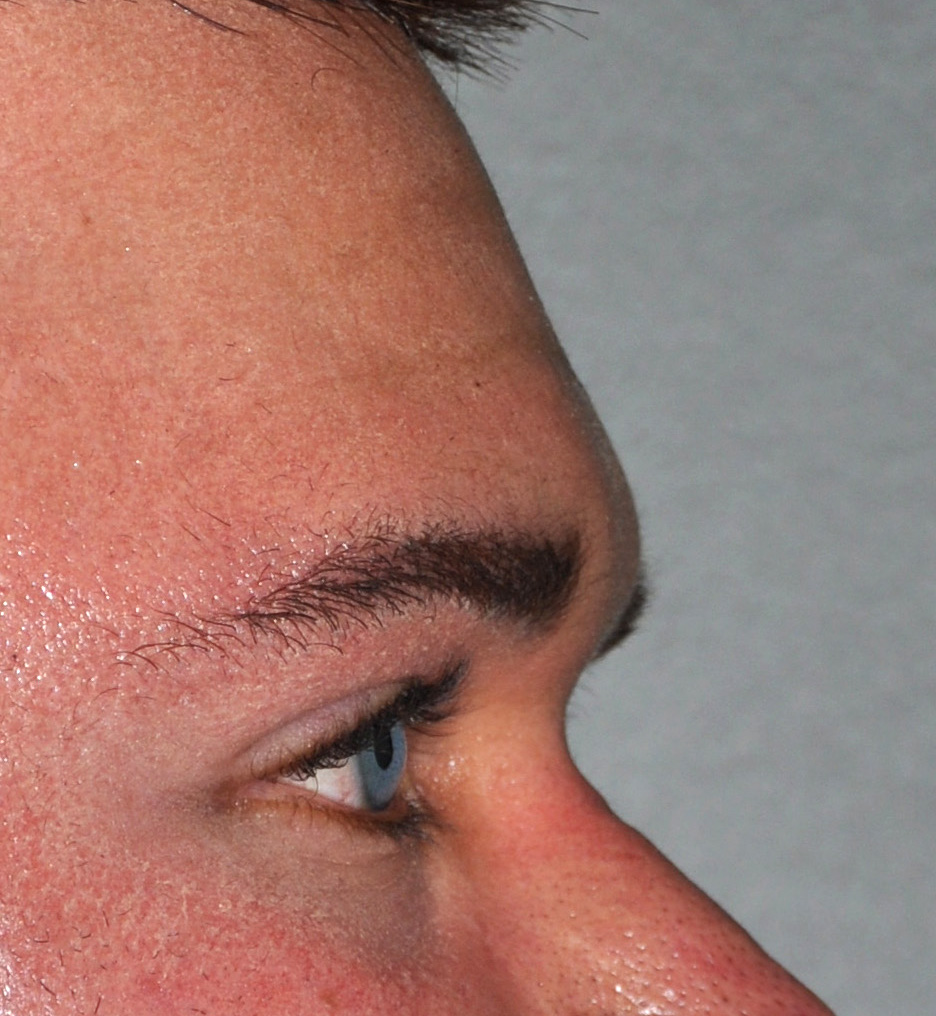 Forehead 9b brow bone implant side after Dr Barry Eppley Indianapolis