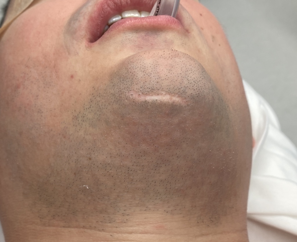 Chin scar placement of custom jawline implant preop Dr Barry Eppley