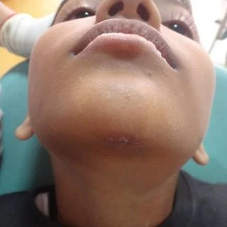 Healing scar over the undersurface of chin Q320