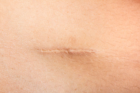 Arlington Dermatology Scars1 1123654265