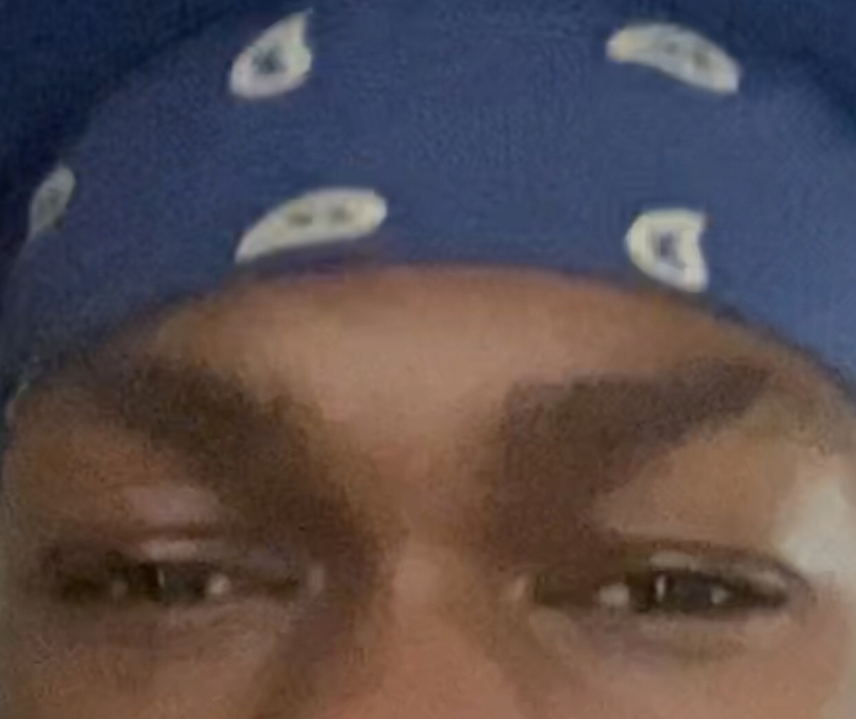 Speedys frauded eye area