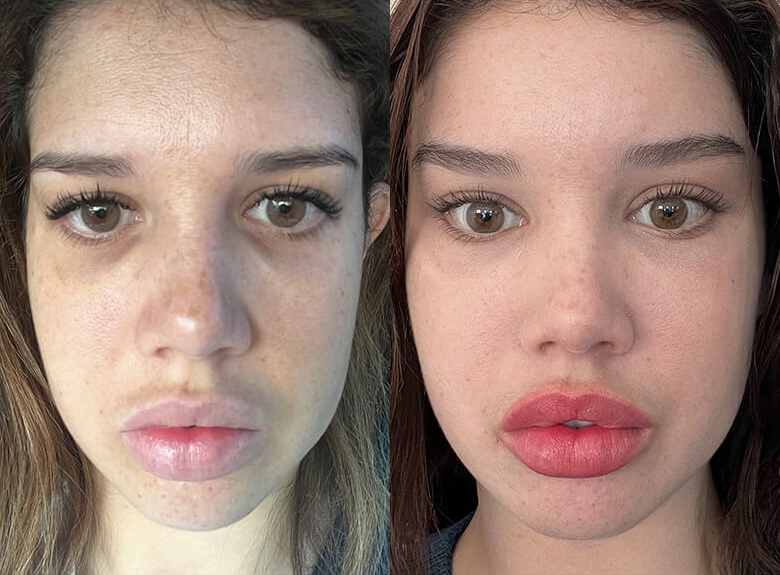 6 9252023 3of8 Facial Fat Transfer before and after photos by Sherber and Rad in Washington DC