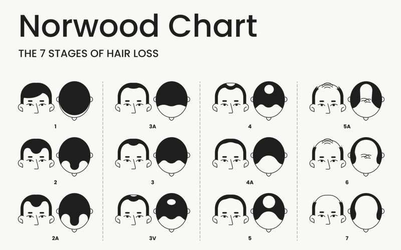hamilton-norwood-scale-hair-loss-chart-1080x675.png