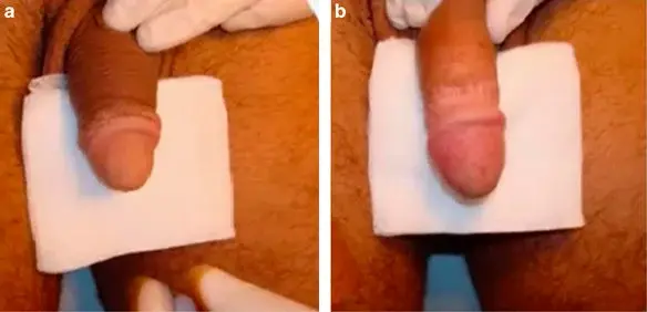 Clinical-situation-a-before-and-b-after-hyaluronic-acid-injection-in-the-glans-penis.webp
