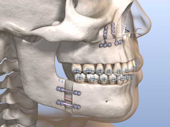 maxillomandibular-advancement-surgery-1200x900.jpg