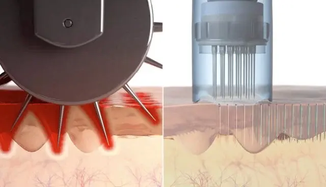 dermapen_vs_dermaroller-640x368.webp